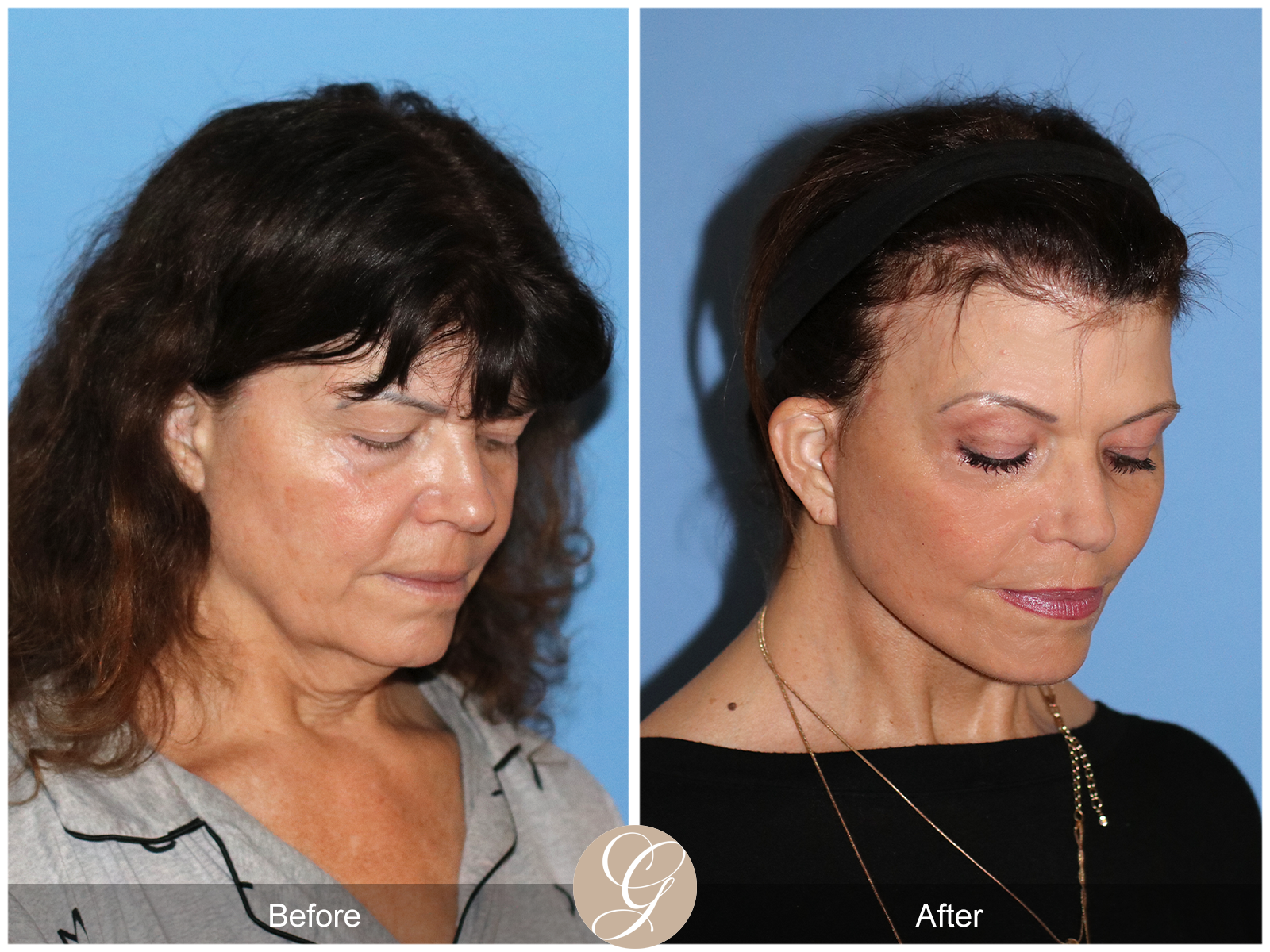 Preservation Deep Plane Facelift Case 51 Image