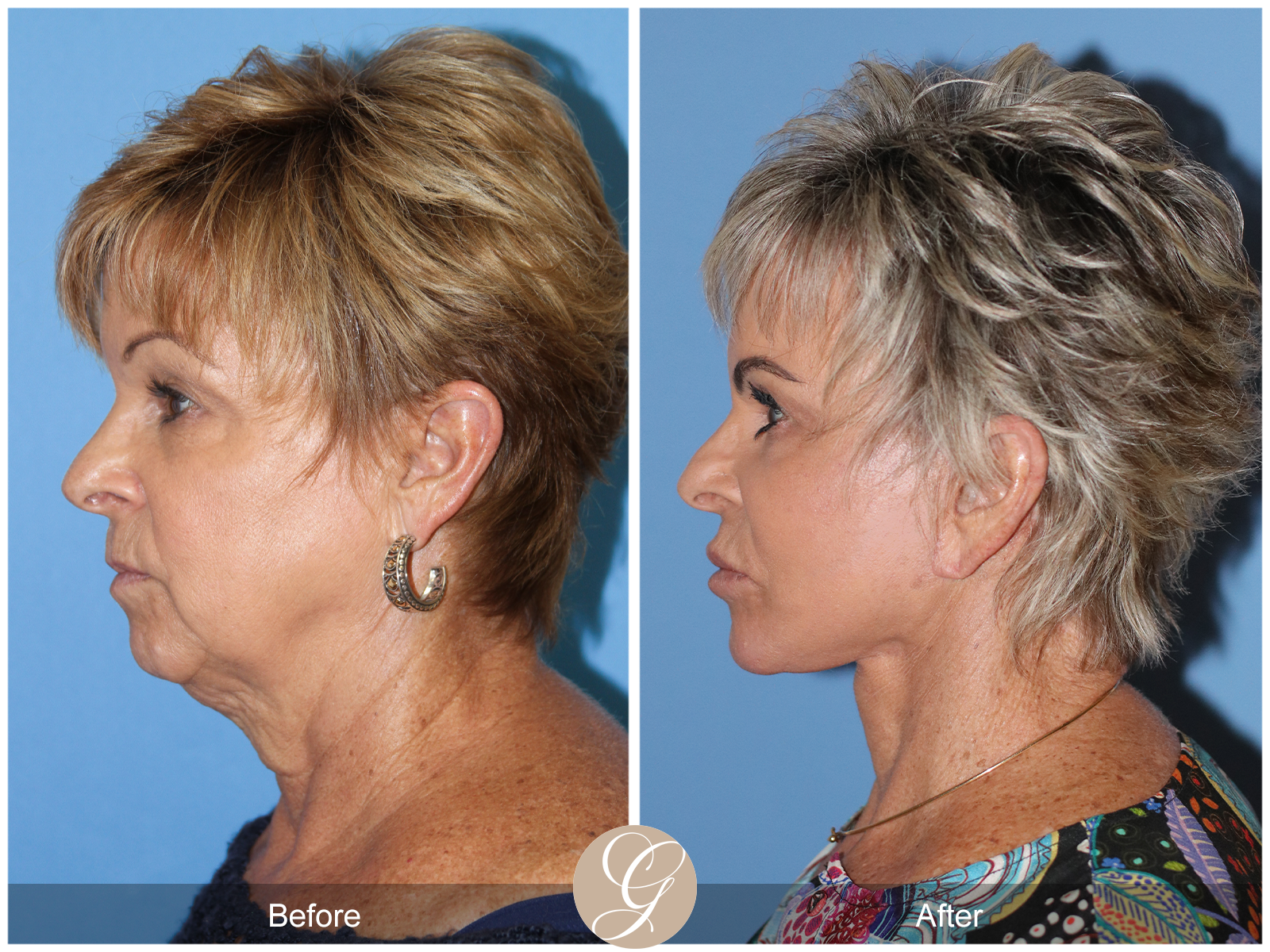 Preservation Deep Plane Facelift Case 52 Image