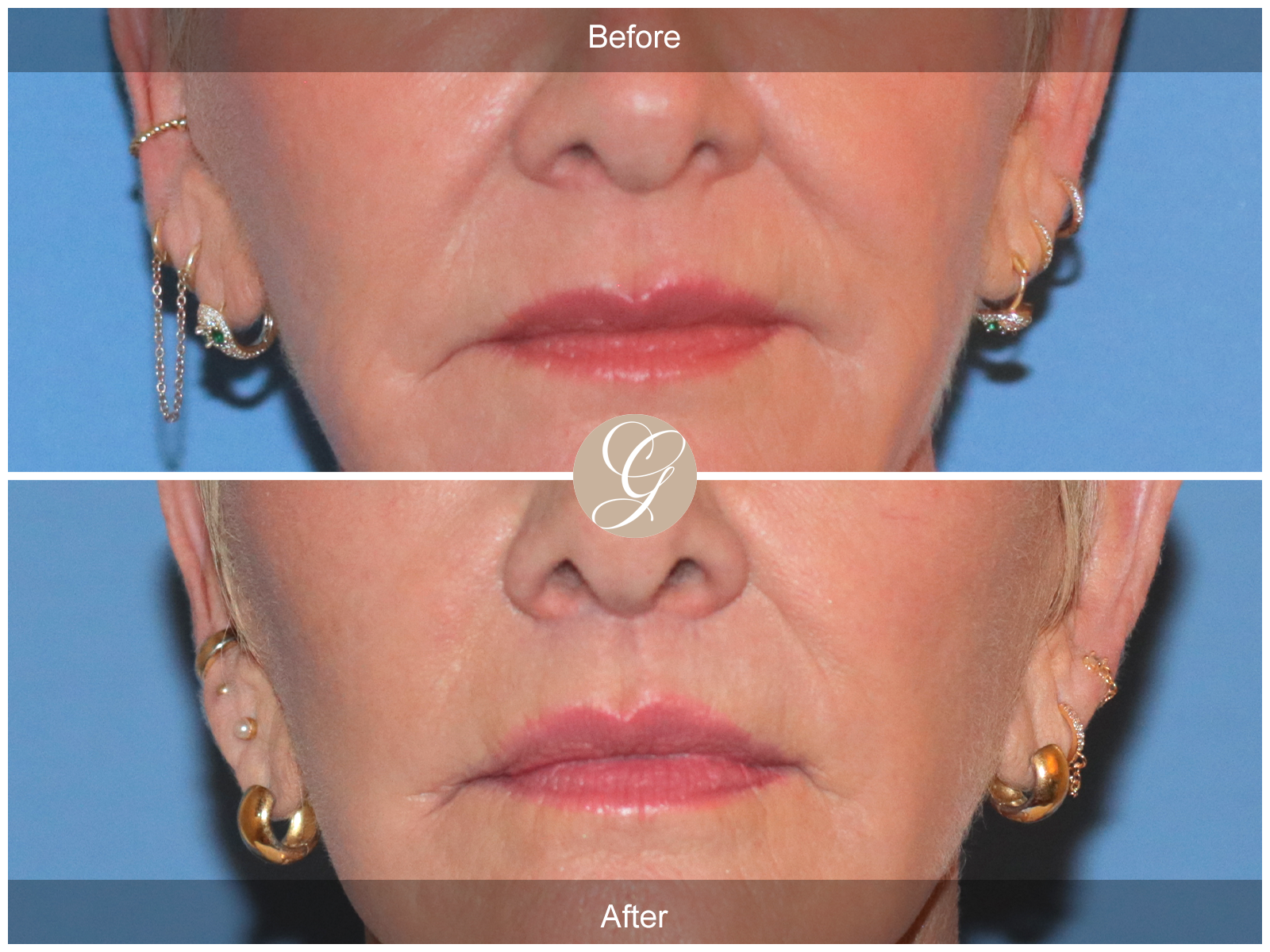 Lip Lift 9221 Image