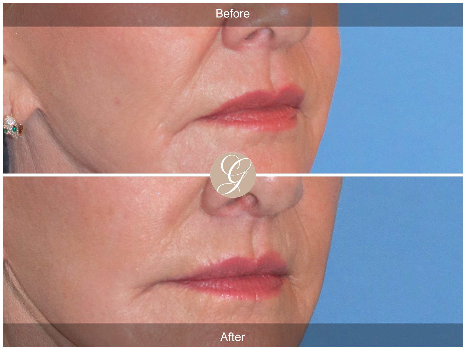Lip Lift 9221 Image
