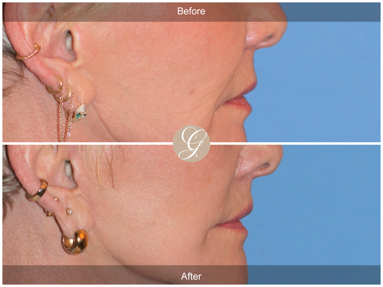 Lip Lift 9221 Image