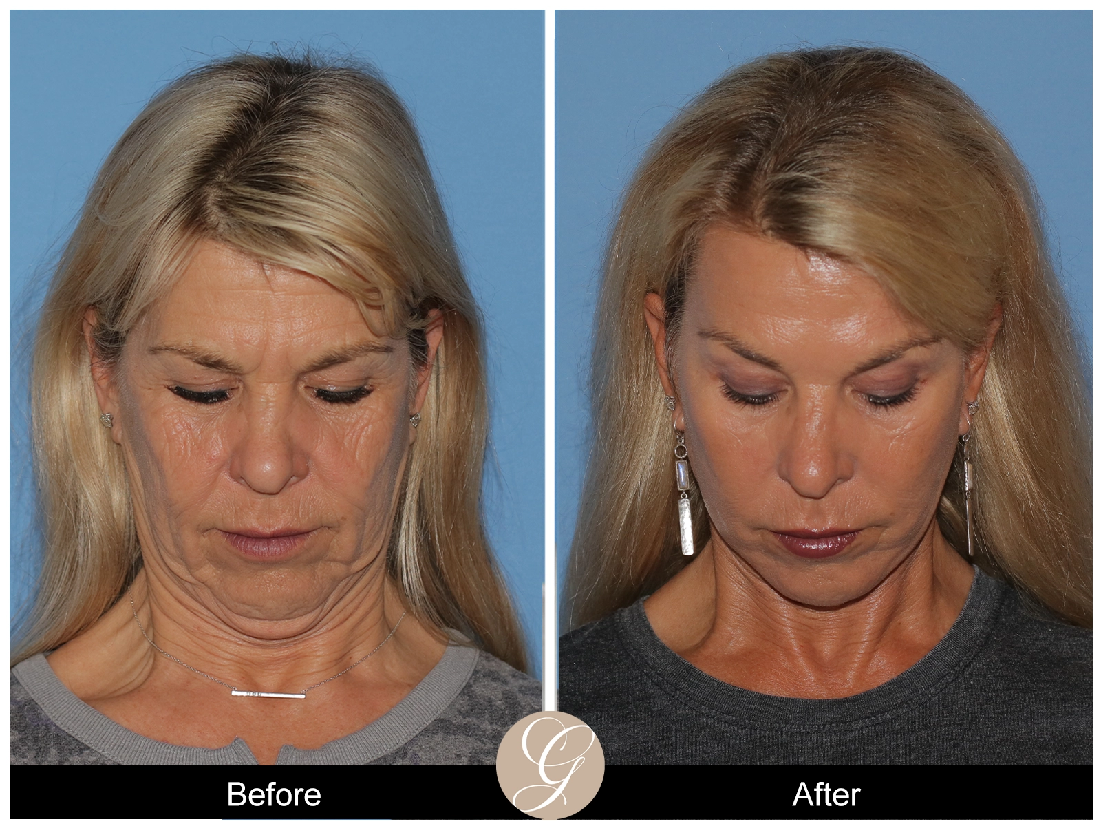 Deep Plane Facelift Case 12 Image