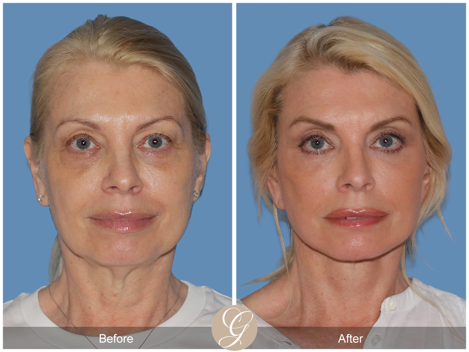 Preservation Deep Plane Facelift Case 26 Image
