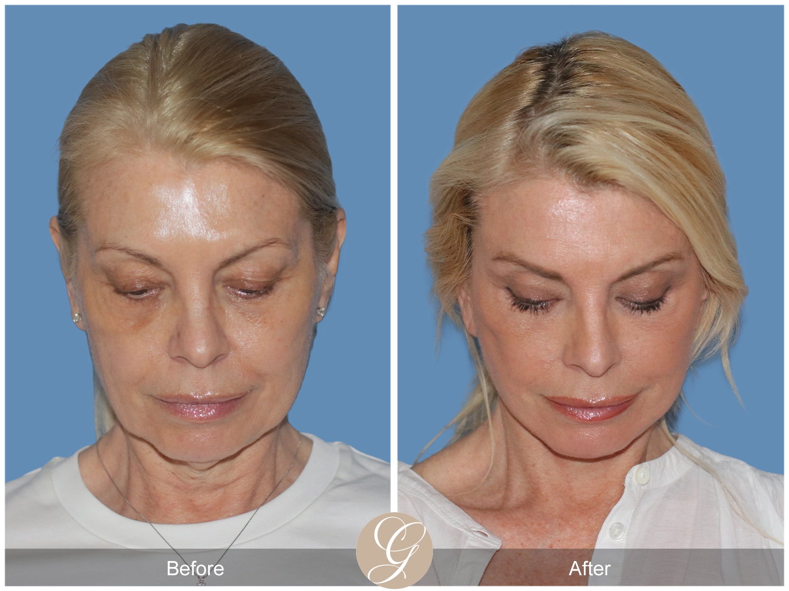 Preservation Deep Plane Facelift Case 26 Image
