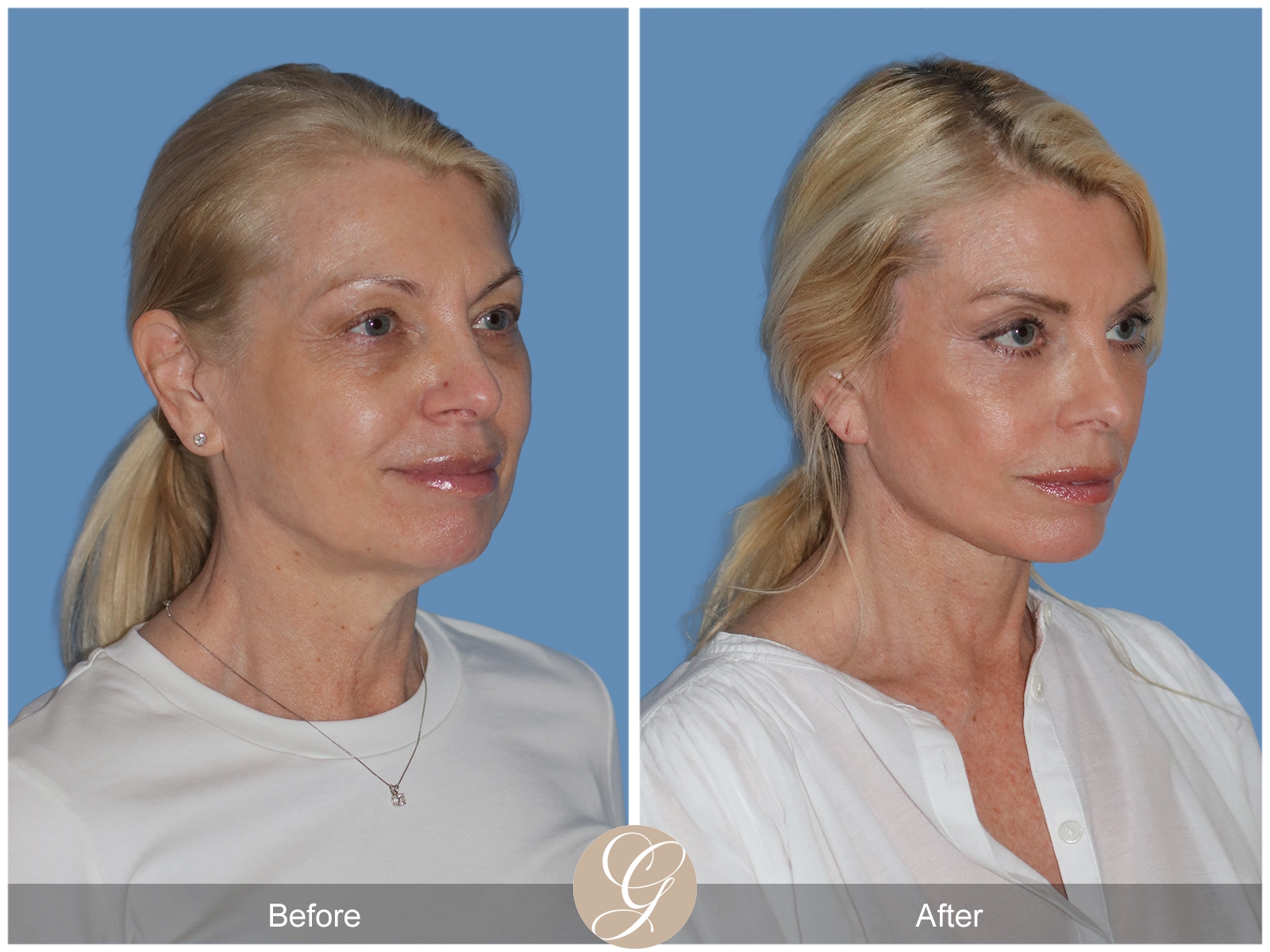 Preservation Deep Plane Facelift Case 26 Image