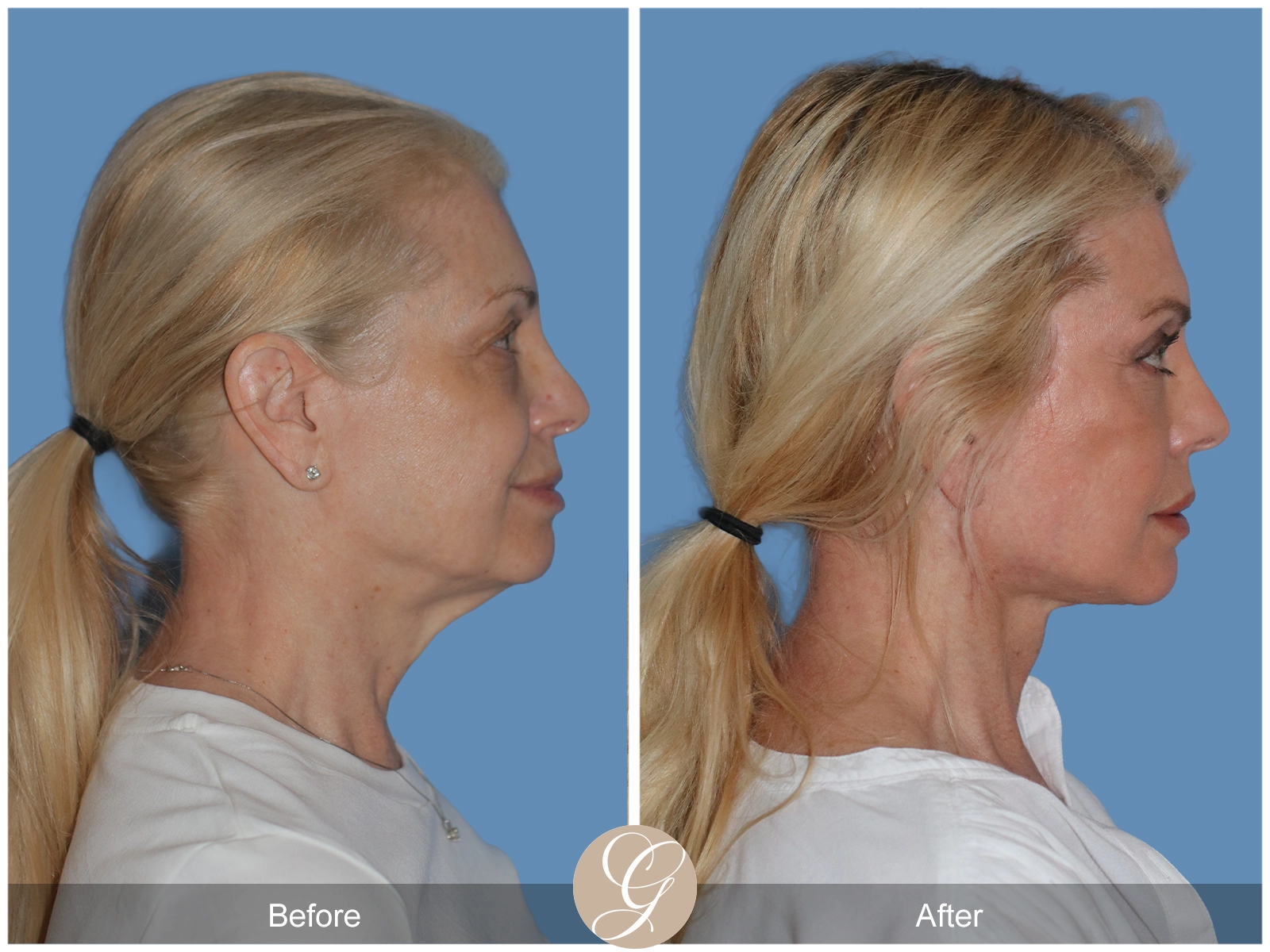 Preservation Deep Plane Facelift Case 26 Image