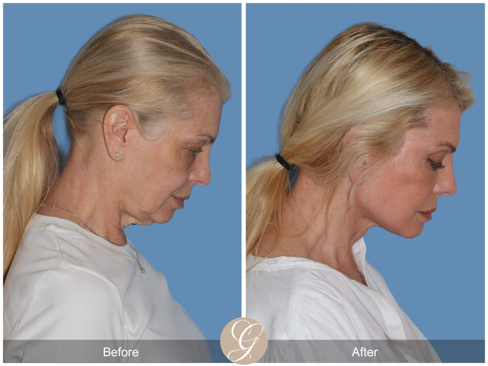 Preservation Deep Plane Facelift Case 26 Image