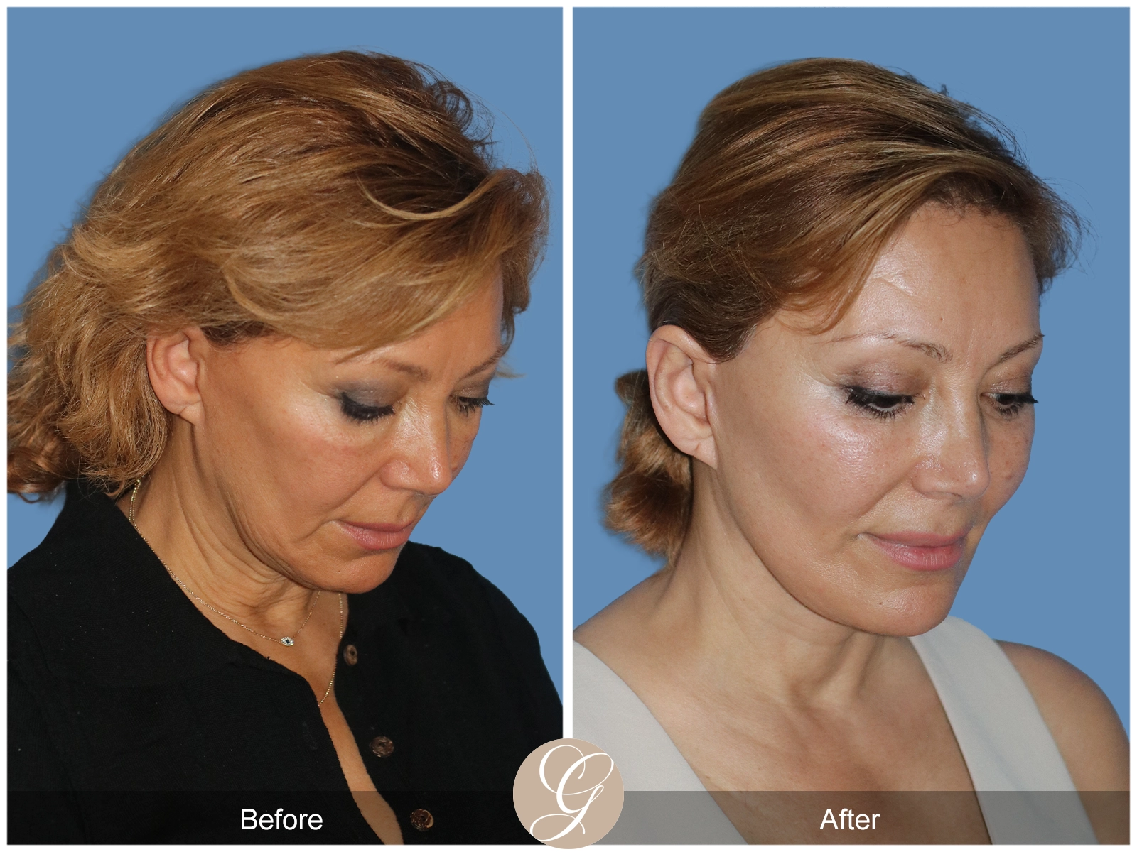 Preservation Deep Plane Facelift Case 55 Image