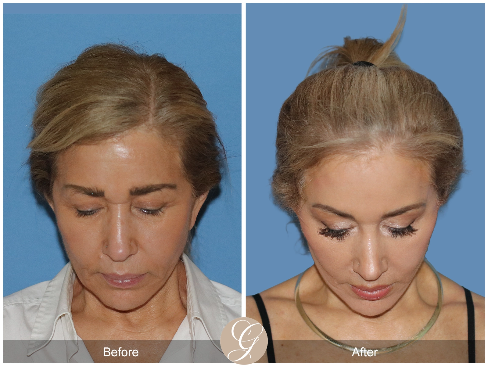 Preservation Deep Plane Facelift Case 54 Image