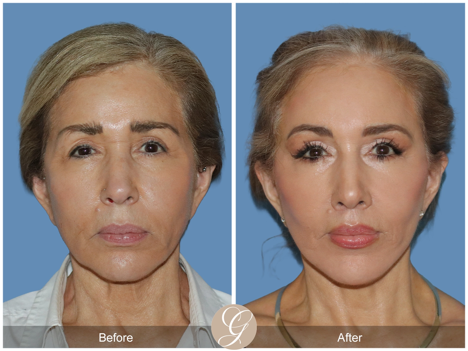 Preservation Deep Plane Facelift Case 54 Image