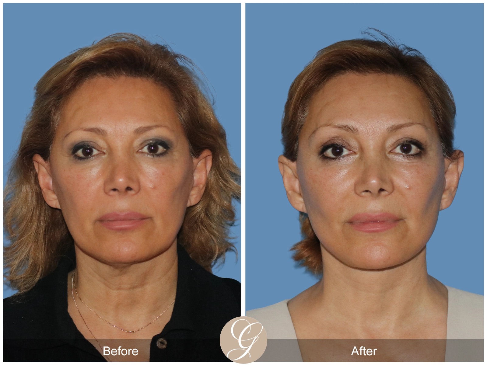 Preservation Deep Plane Facelift Case 55 Image
