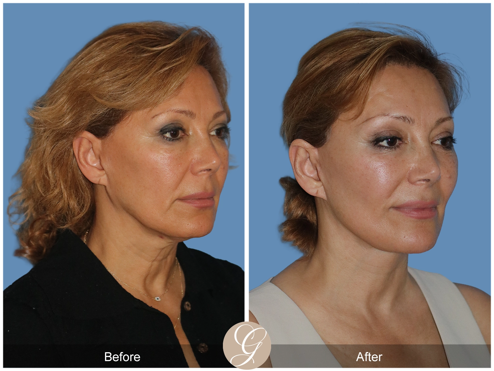 Preservation Deep Plane Facelift Case 55 Image
