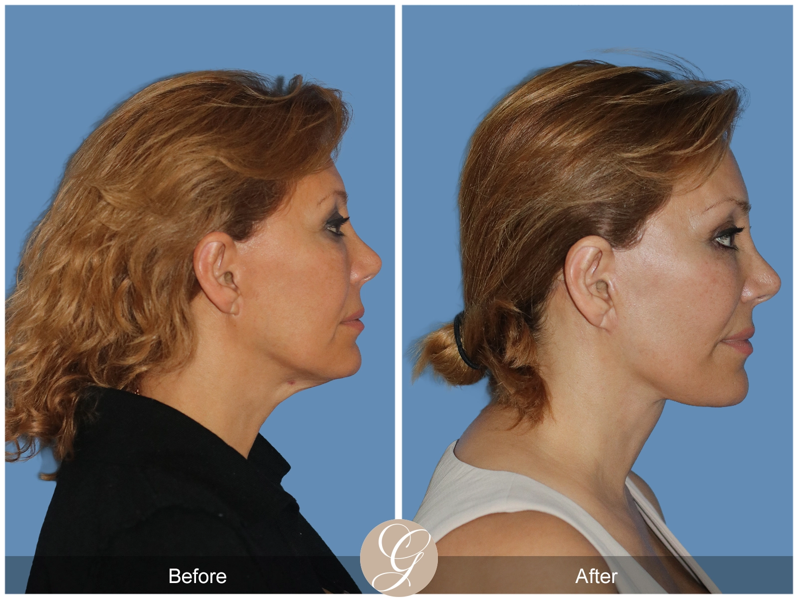 Preservation Deep Plane Facelift Case 55 Image