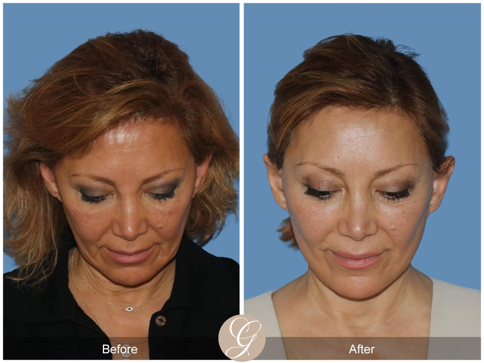 Preservation Deep Plane Facelift Case 55 Image