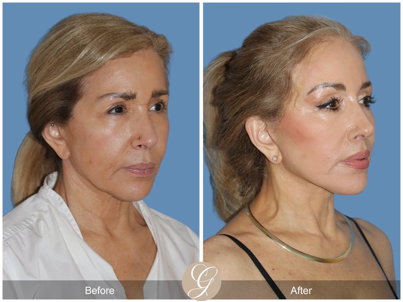 Preservation Deep Plane Facelift Case 54 Image