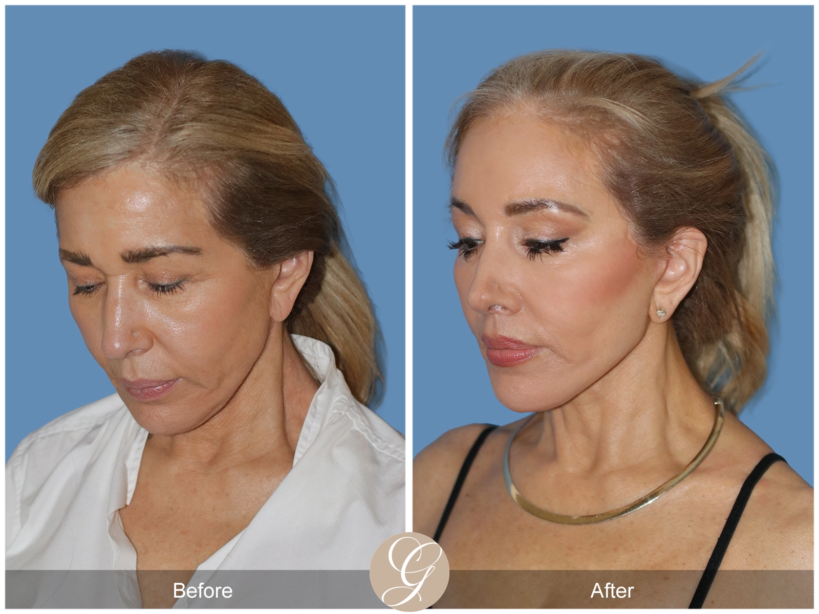 Preservation Deep Plane Facelift Case 54 Image