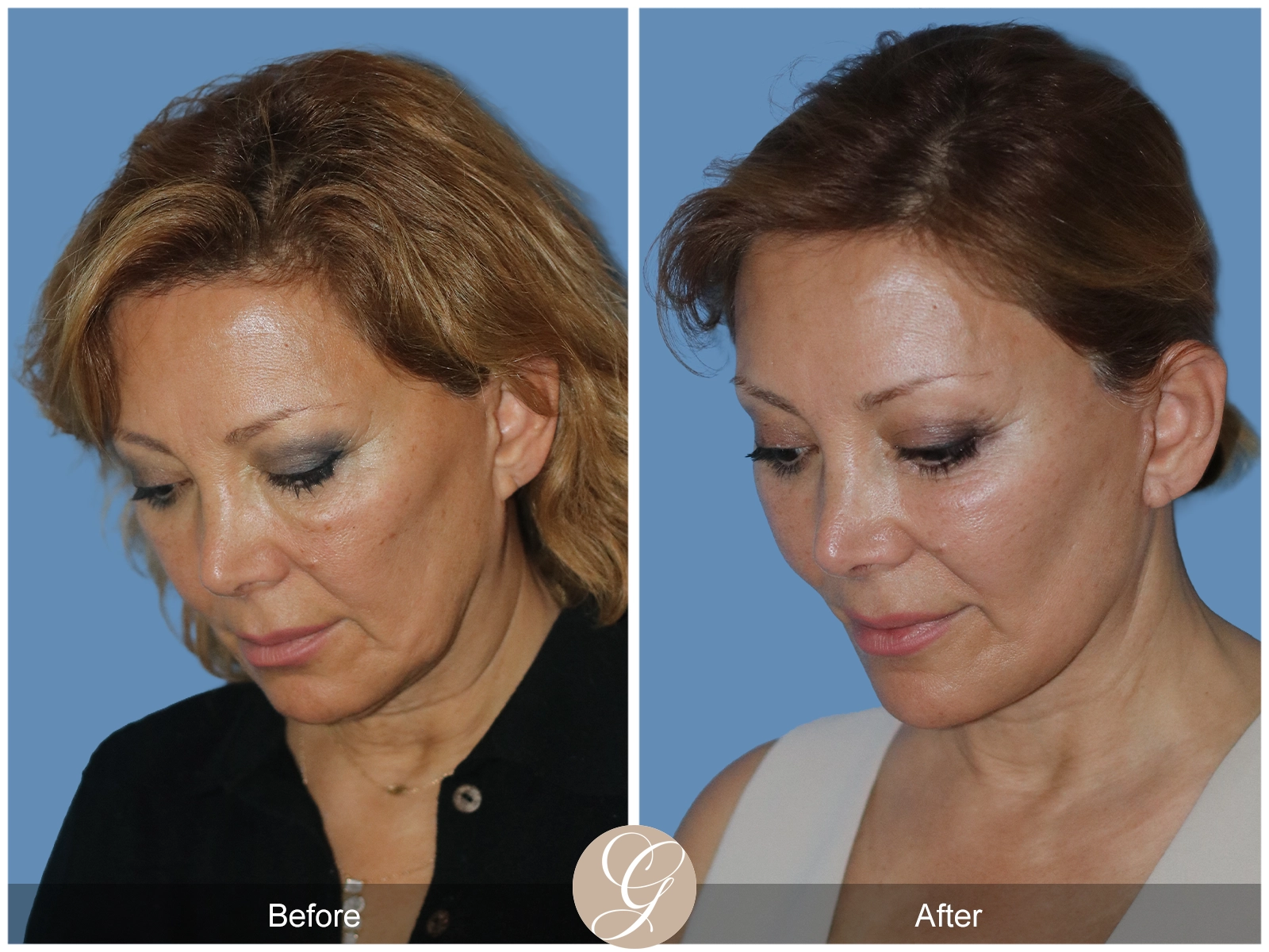 Preservation Deep Plane Facelift Case 55 Image