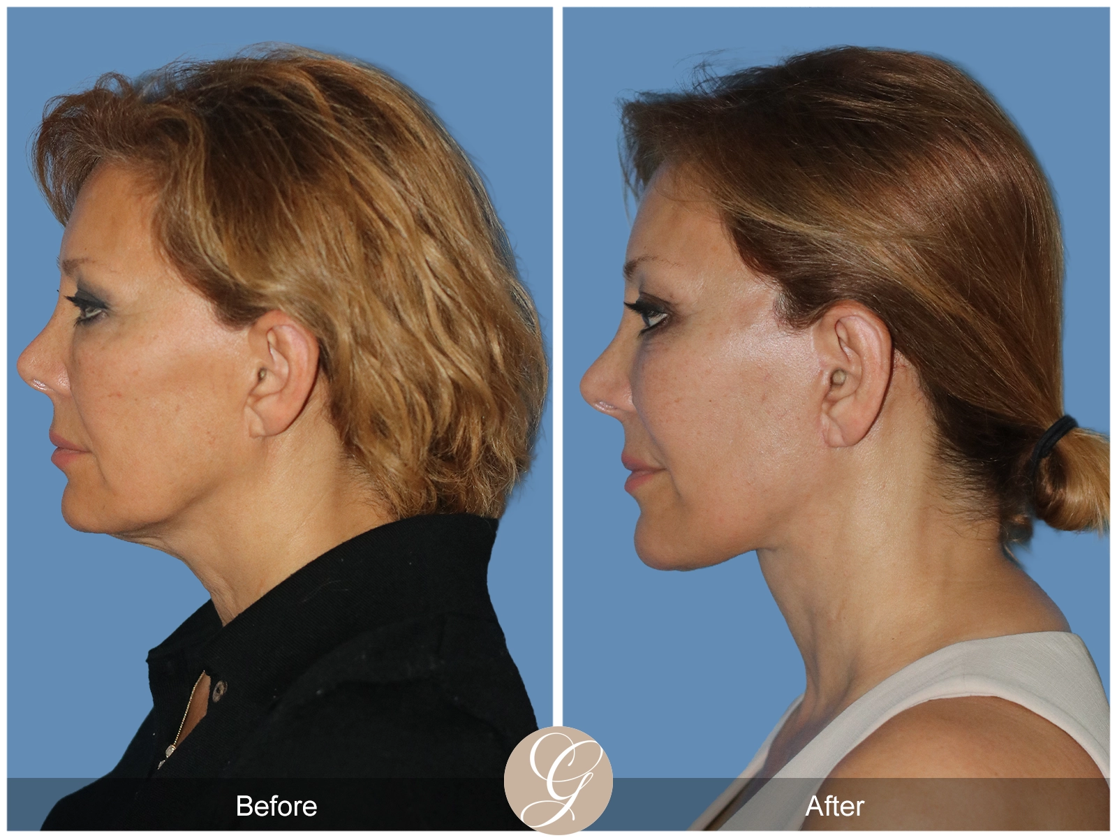 Preservation Deep Plane Facelift Case 55 Image