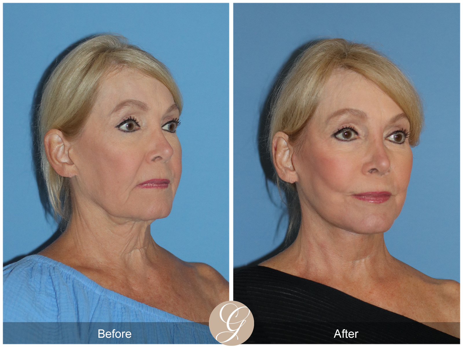 Preservation Deep Plane Facelift Case 103 Image