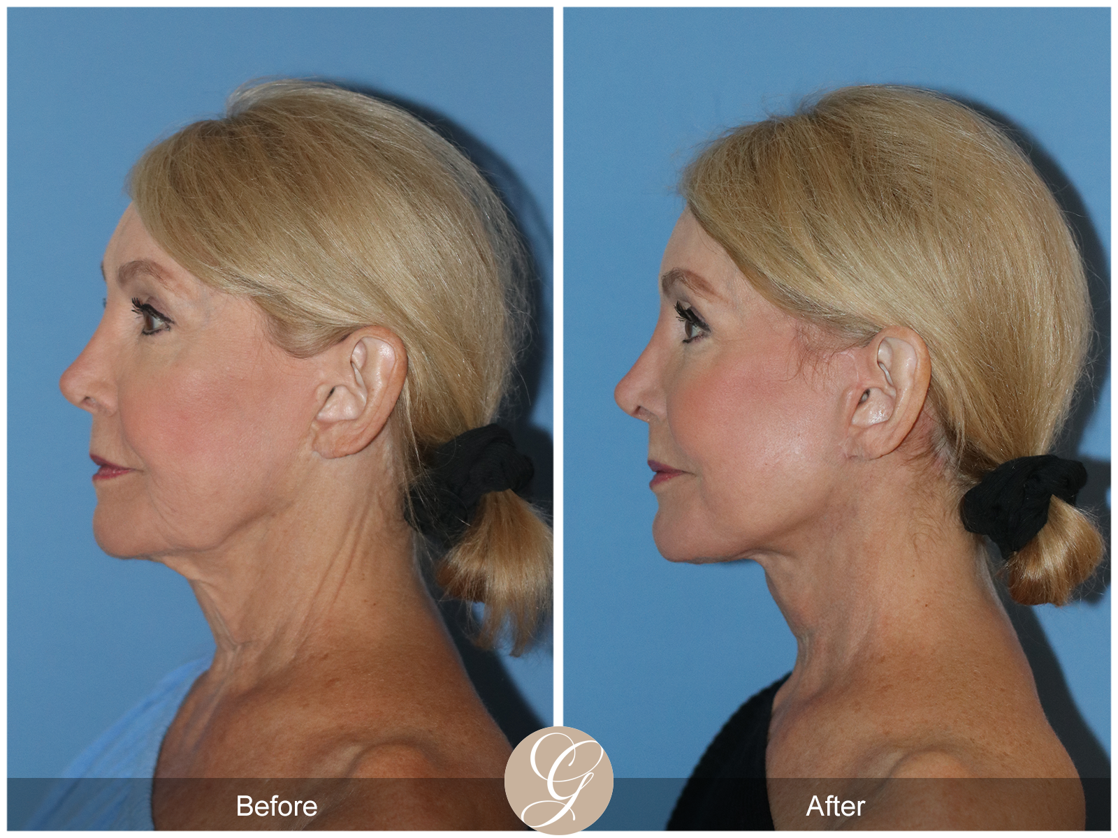 Preservation Deep Plane Facelift Case 103 Image