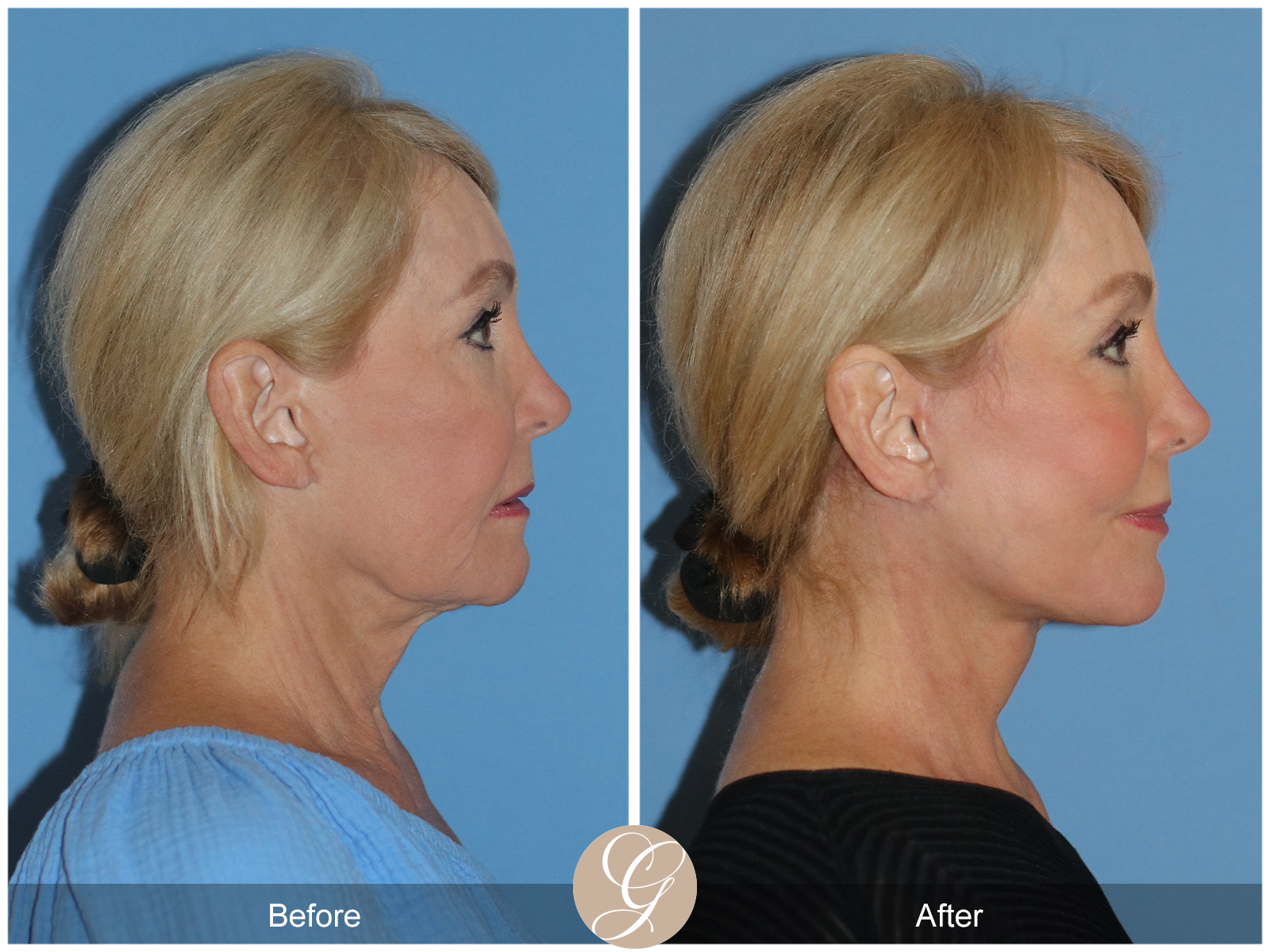 Preservation Deep Plane Facelift Case 103 Image
