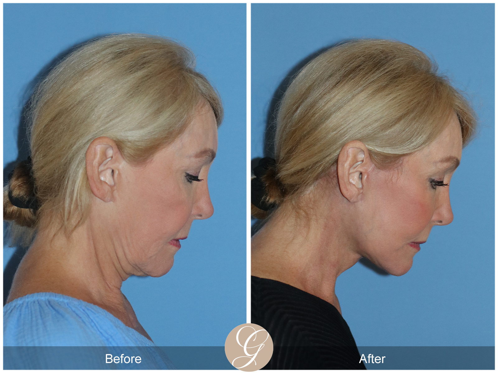 Preservation Deep Plane Facelift Case 103 Image