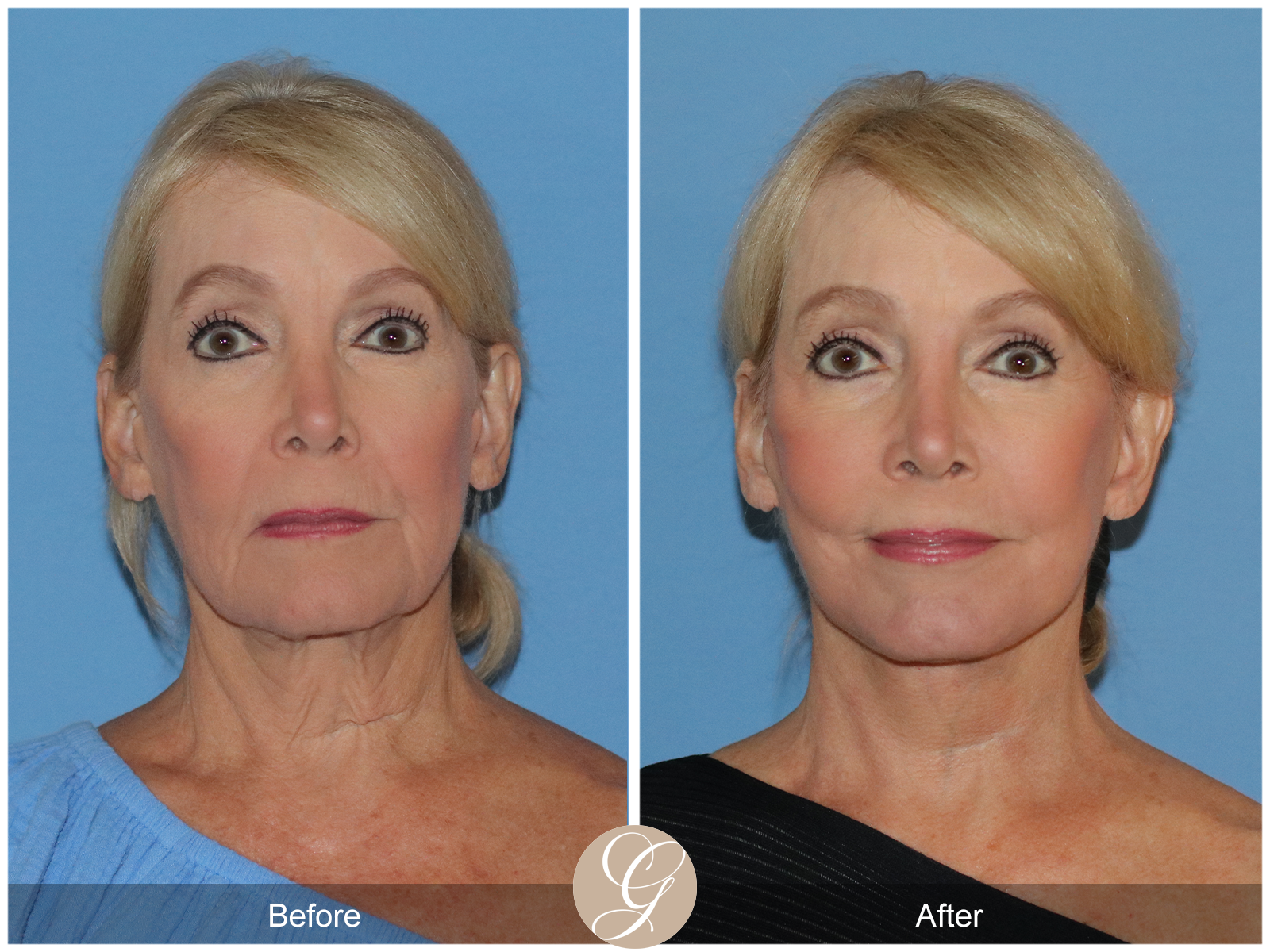 Preservation Deep Plane Facelift Case 103 Image