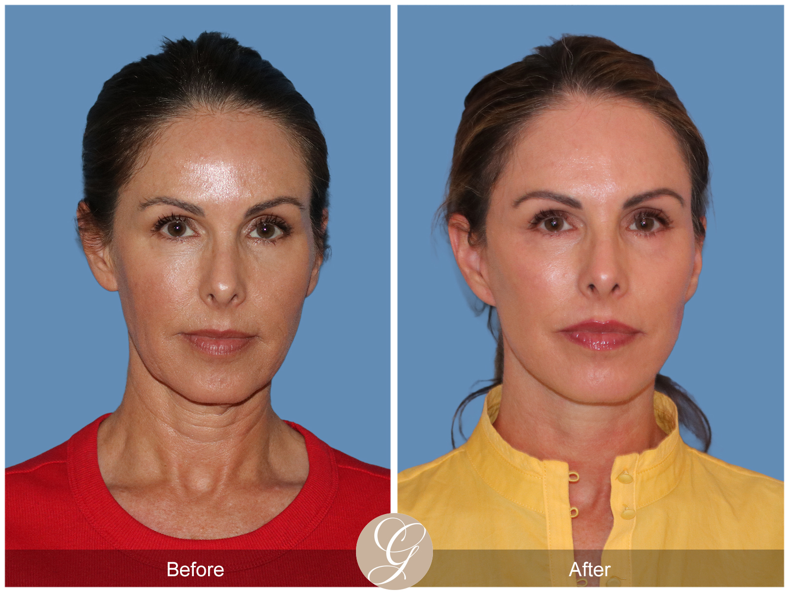 Preservation Deep Plane Facelift Case 102 Image