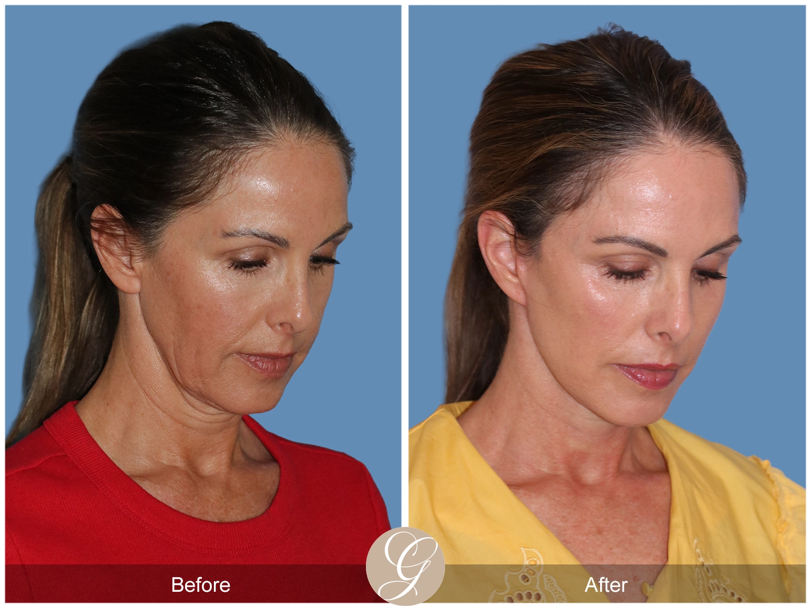 Preservation Deep Plane Facelift Case 102 Image