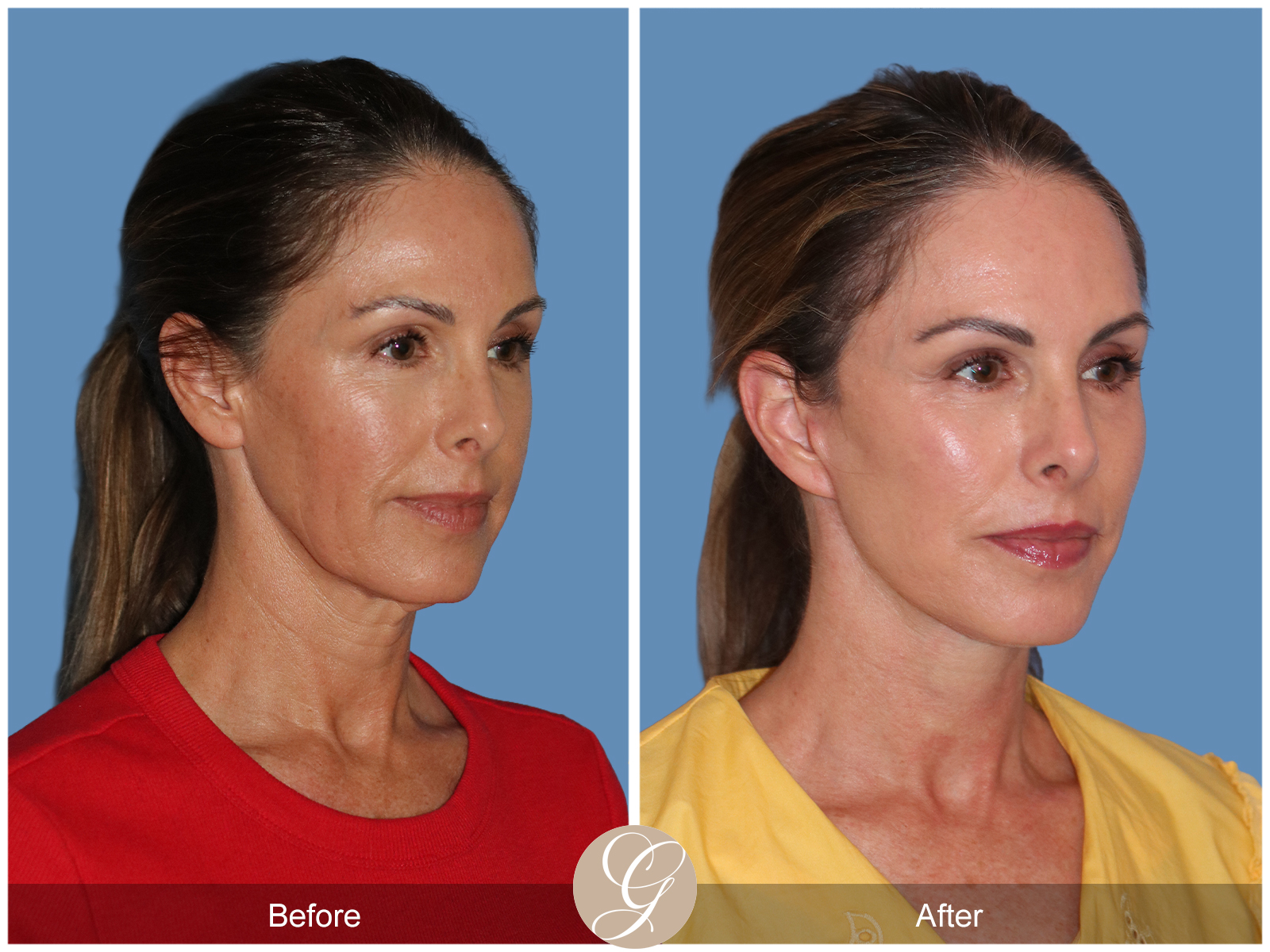 Preservation Deep Plane Facelift Case 102 Image