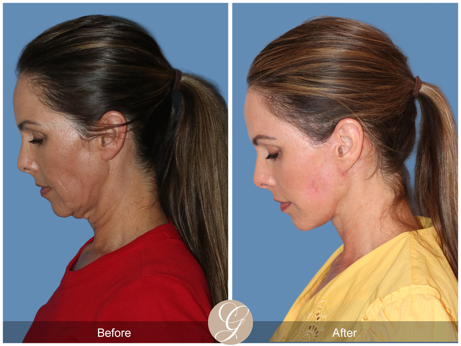 Preservation Deep Plane Facelift Case 102 Image