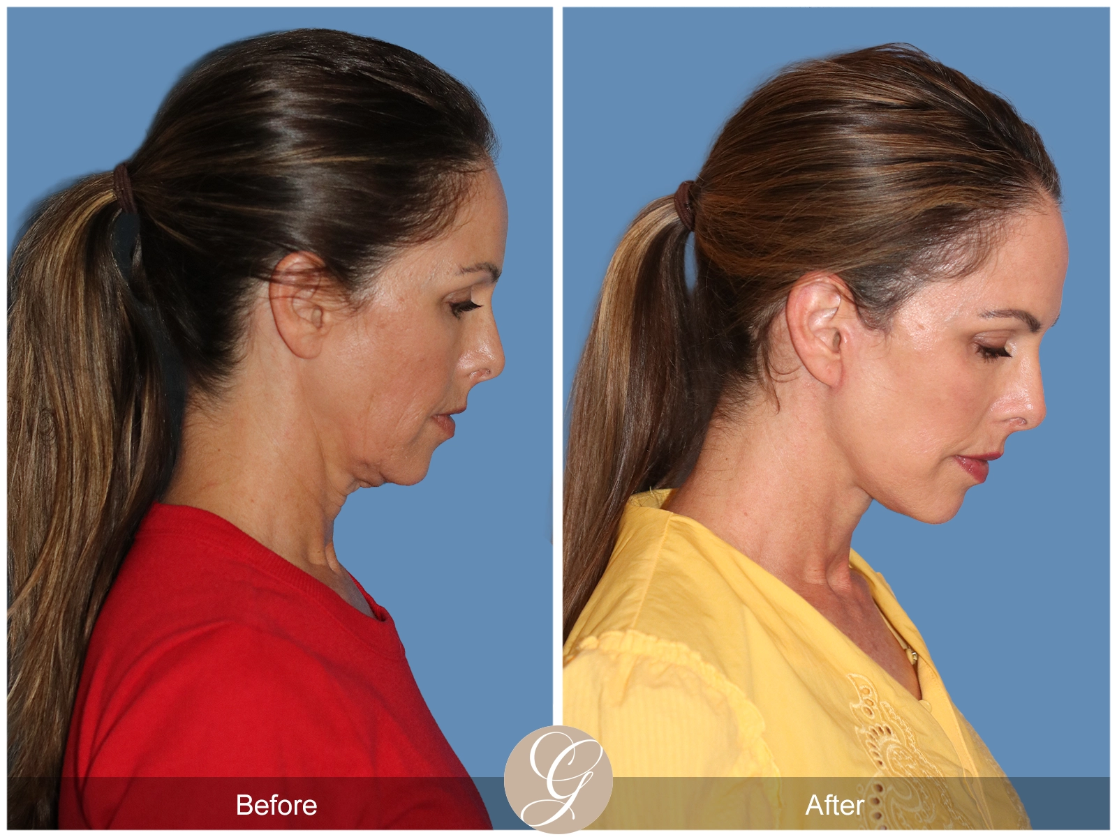 Preservation Deep Plane Facelift Case 102 Image
